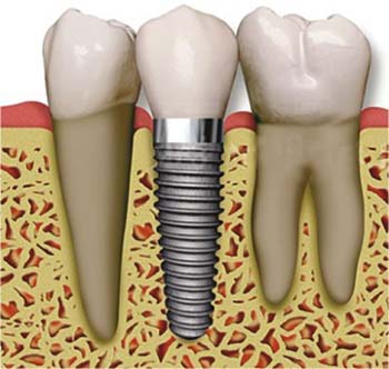Implant Nedir Dis Implanti Tedavisi Kimlere Uygulanir